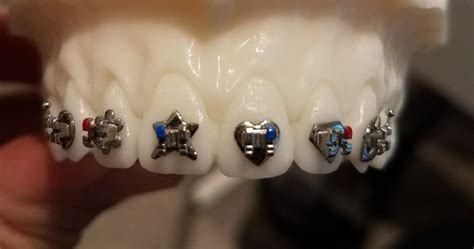 wild style metal brackets braces|Wild Smiles .